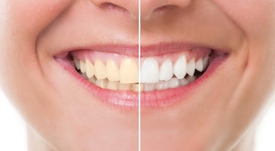 A before & after of teeth whitening treatments.