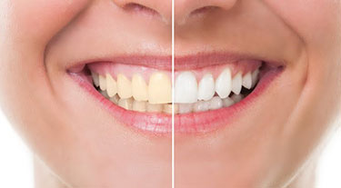 Woman showing before and after images of her teeth to display her teeth whitening results after using Zoom! Teeth Whitening